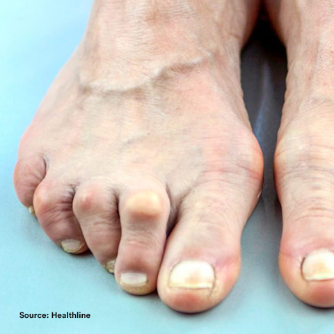 A foot and ankle with athritis
