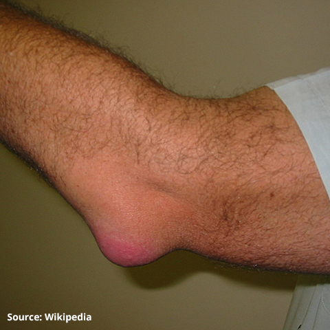 A swollen elbow