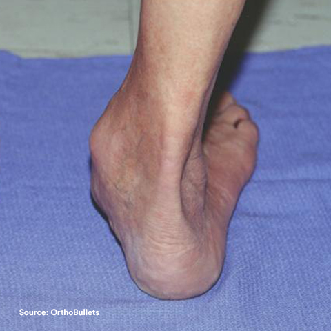 a foot with posterior tibial tendon dysfunction
