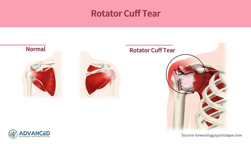Shoulder Rotator Cuff Tear