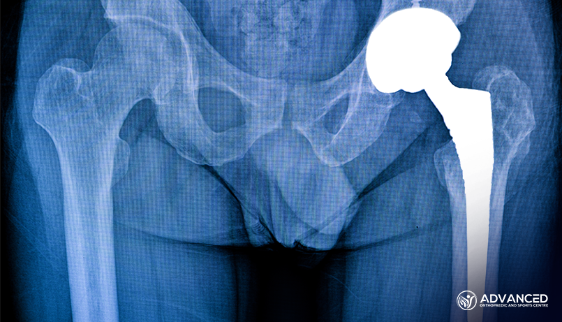 Hip Replacement Surgery in Singapore Patient-specific instrumentation