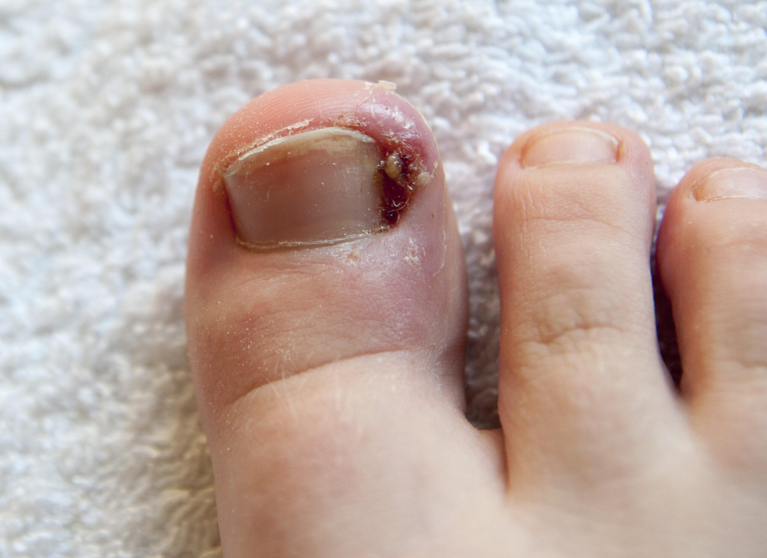 Onychomycosis - Symptoms and when to see a doctor! by Jennifer Levine -  Issuu