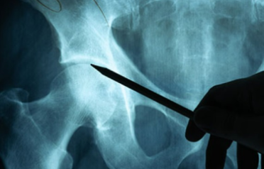 hip-surgery-specialist-in-singapore