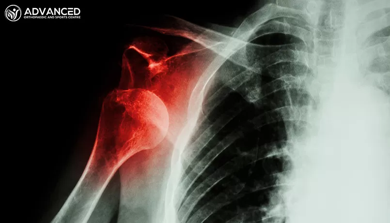 Rotator Cuff Tears