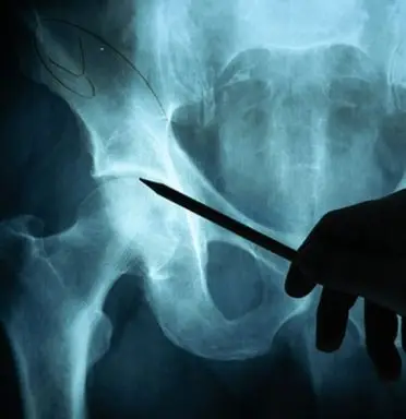 hip-surgery-specialist-in-singapore