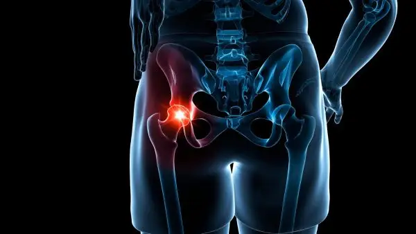 Hip Labral Tear