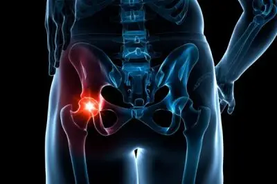 Hip Labral Tear - Mobile