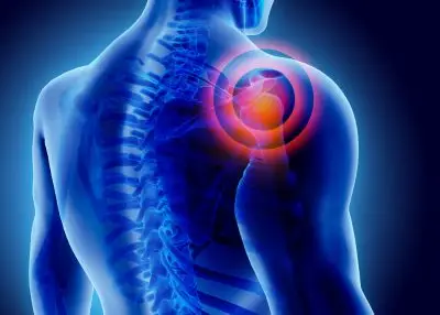 3d,Illustration,Of,Shoulder,Painful,,Medical,Concept.