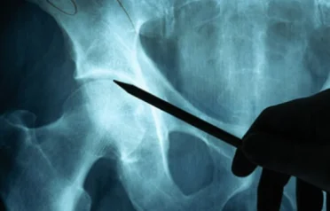 hip-surgery-specialist-in-singapore