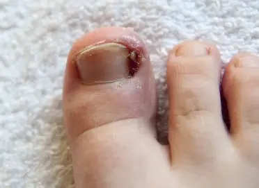 AO-ingrown-symptoms